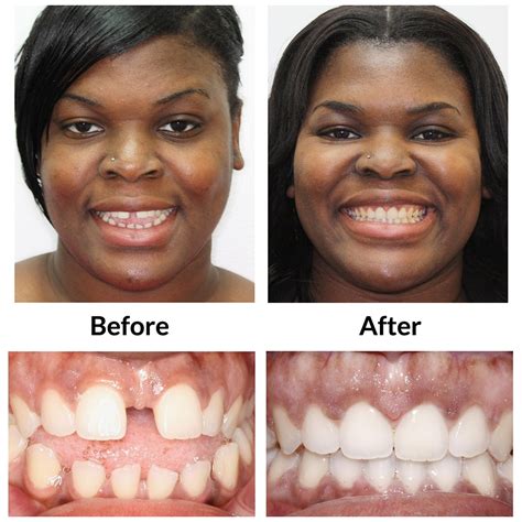 Invisalign In Honolulu Hi Queen S Crown Dental