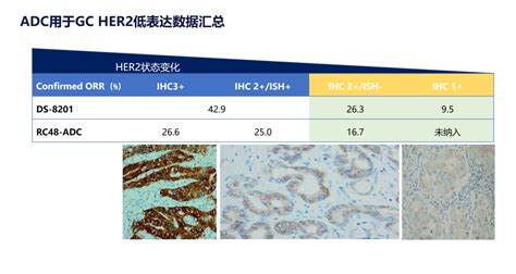 2023年her 2阳性胃癌治疗新突破胃癌靶向药物化疗 健康界