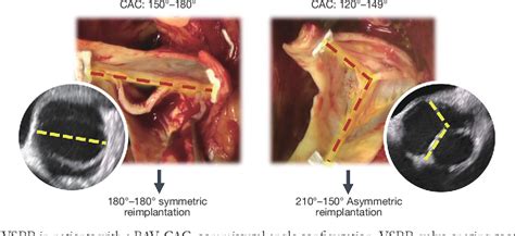 Figure From Outcomes Of Aortic Valve Repair With The Reimplantation