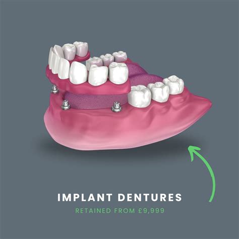 Cobalt Chrome Dentures In London From £850 Theyre Better