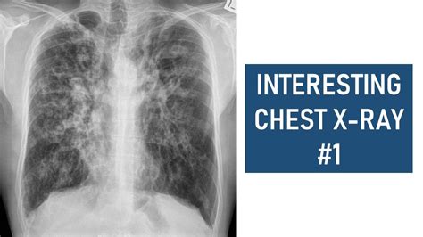 Cystic Fibrosis Lateral Chest X Ray Calgary Guide Porn Sex Picture