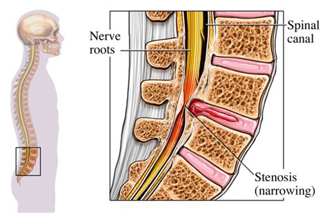 What Is Lumbar Spinal Stenosis The Spine Center