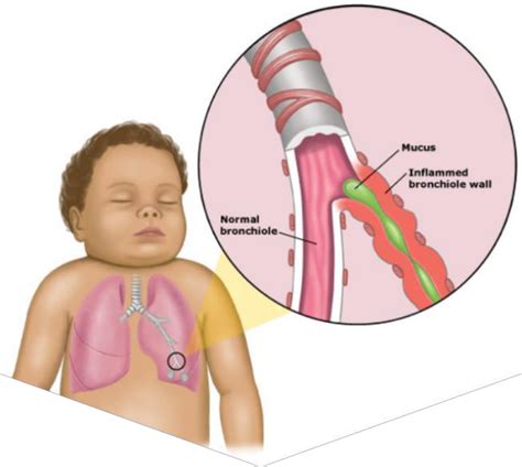 Croup Epiglotittis Bronchiolitis Flashcards