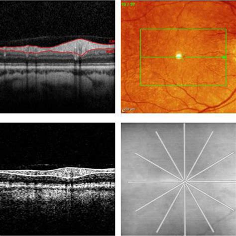 Comparative Time Domain And Spectral Domain Oct Scans Of Peripapillary