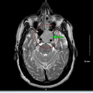 Coronal T1 Weighted MRI Sequence Showing Hypointense 35 Mm 33 Mm