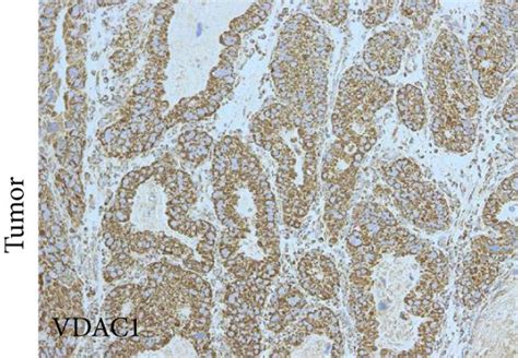 Expression Of The Oxphos Complexes And Porin In Intestinal Gc Case