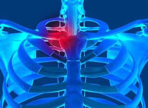 Lesi N De La Articulaci N Esternoclavicular Dr Byron Torres