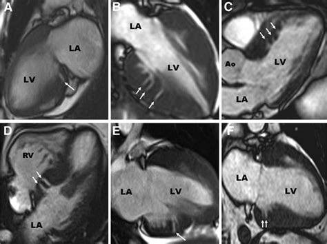 Prevalence And Clinical Profile Of Myocardial Crypts In Hypertrophic