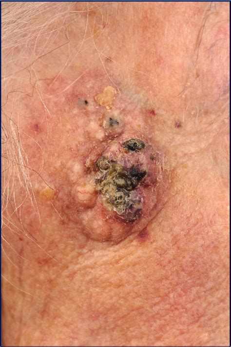 Multifocal Squamous Cell Carcinoma Arising In A Favre Racouchot Lesion