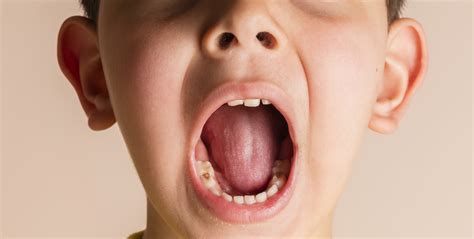 Cavities and Kids: What Parents Should Know and Expect - Gilbert ...