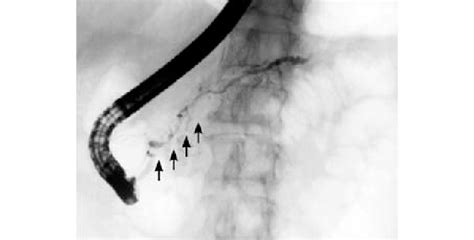 Ercp Showing Diffuse Irregular Stenosis Of The Pancreatic Duct Caused Download Scientific