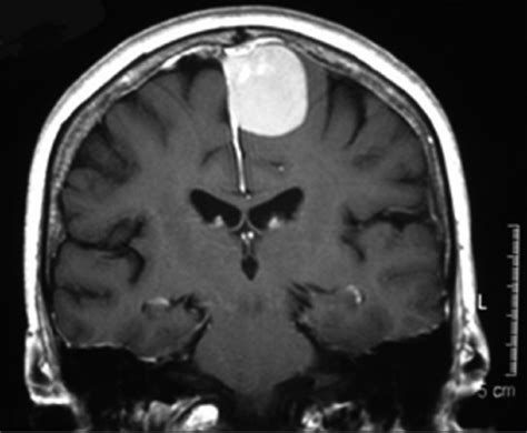 Coronal T1 Weighted Contrast Enhanced Scan Showing Homo Open I