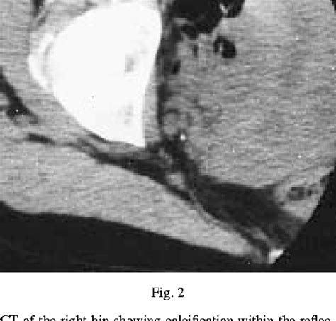 Figure From Acute Calcific Tendinitis Of The Rectus Femoris 1298 Hot Sex Picture