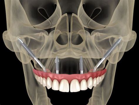 Zigoma İmplantı Nedir Dentallaid