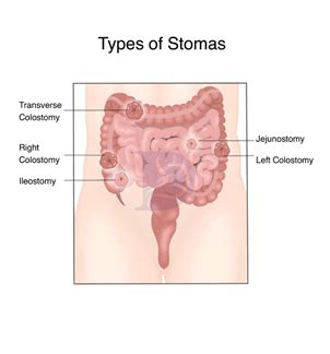 Learn About Ostomy Colostomy And Ileostomy The GIDocs