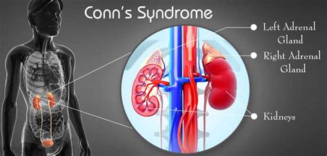 Conn Syndrome - Istanbul Plastic Surgeon English