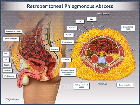 Retroperitoneal Phlegmonous Abscess Trialquest Inc