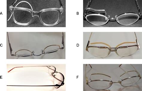 Figure 3 From A Modular And Adjustable Ptosis Crutch As A Non Surgical