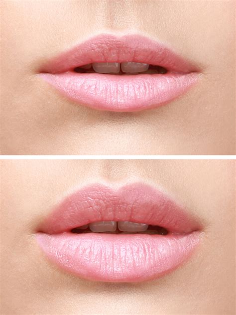 Lippen aufspritzen Linz Lippenvergrößerung Lippenkorrektur Dr Koller