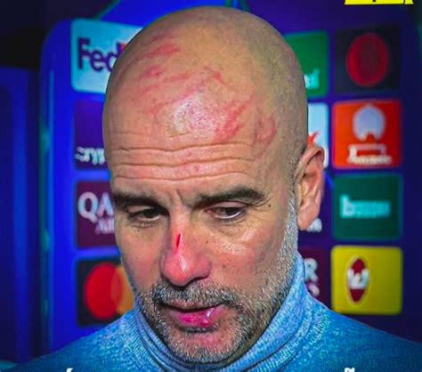 Guardiola Se Vuelve Viral Por Heridas En El Rostro Tras Empate En