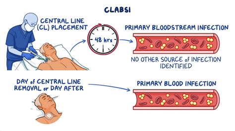 Central line-associated bloodstream infection: Clinical sciences ...