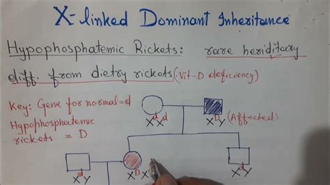 X Linked Dominant Inheritance Hypophosphatemic Ricket Vitamin D