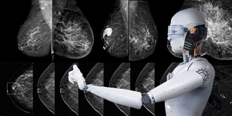 Faster And More Accurate AI Boosts Success In Breast Cancer Detection