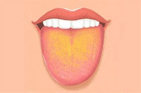 What Is Yellow Tongue Causes Symptoms And Treatments Selectivediet