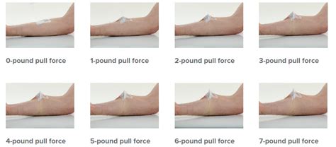 Iv Complications Lineus Medical