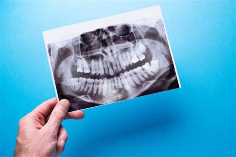 Benefits Of Panoramic Dental X Ray Smart Dental Teleradiology