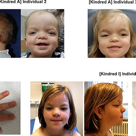 Heterozygous Variants In Cdh Change Cell Substrate Adhesion And