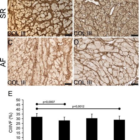 Collagen I In The Atrial Myocardium A D Immunohistochemical Reaction