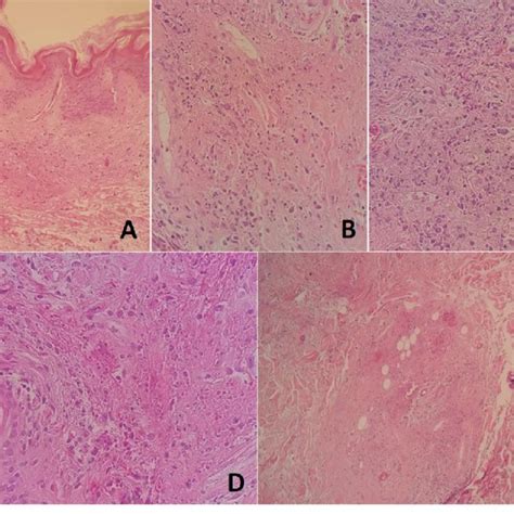 Skin Biopsy Histopathology Showing Slight Hyperkeratosis In The