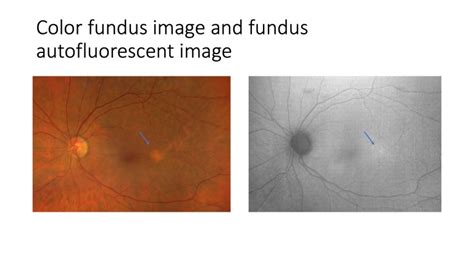 Other Retinal Issues Scott E Pautler Md Tampascott E Pautler Md Tampa Treatment Of