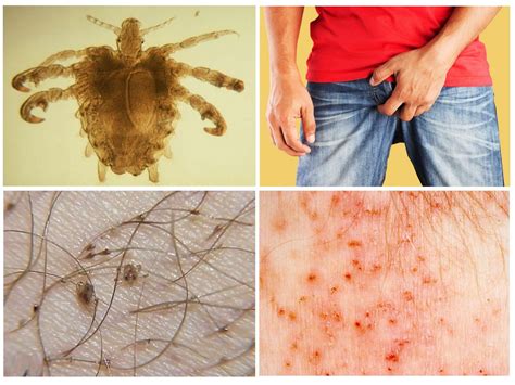 Мандавошки: признаки появления, откуда они берутся, основные методы ...