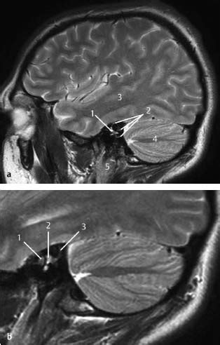 Radiologic Anatomy of the Skull Base | Radiology Key