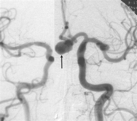 Cerebral Aneurysm Angiogram