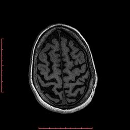 Choroid Plexus Xanthogranuloma Radiopaedia Axial T Nc