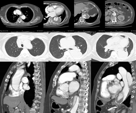 Upper Enhanced Computed Tomography Imaging A Preoperative Ct Scan