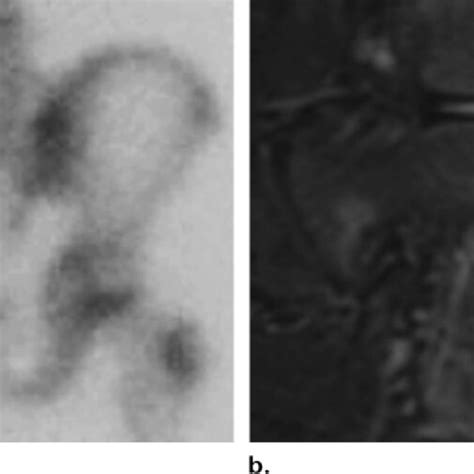 Stress injury of the ischial tuberosity in a 13-year-old male ...