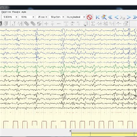 Critical Eeg Showing Generalized Spike Wave Puffs And Discharges Of