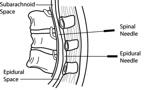 Intrathecal Vs Epidural Space