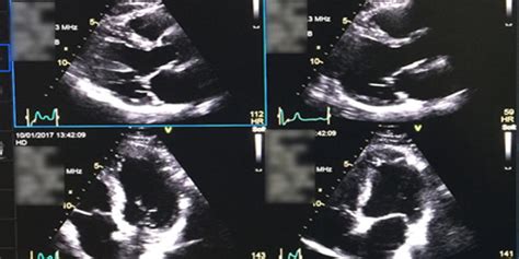 Stress Echocardiography (also called Stress Echo) - HeartWest