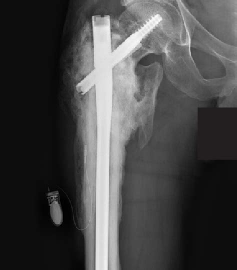 Revision to cephalomedullary nail. Anteroposterior radiograph at 1-year ...