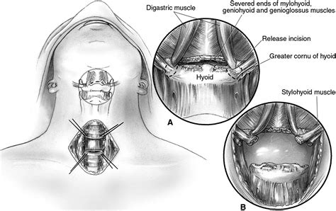 Thoracic Surgery Techniques In Open Tracheal Surgery For Tracheal