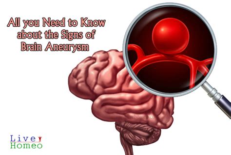 All You Need To Know About The Signs Of Brain Aneurysm Live Homeo