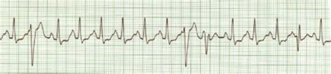 Ekg 12 Sinus Tachycardiapvcs