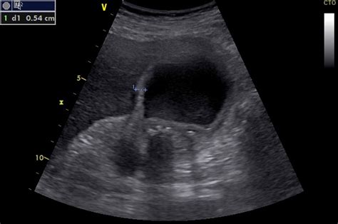Cholécystite Aiguë Lithiasique Echo Urgences