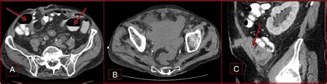 Diversion Ahead Imaging Appearance Of Urinary Diversions And