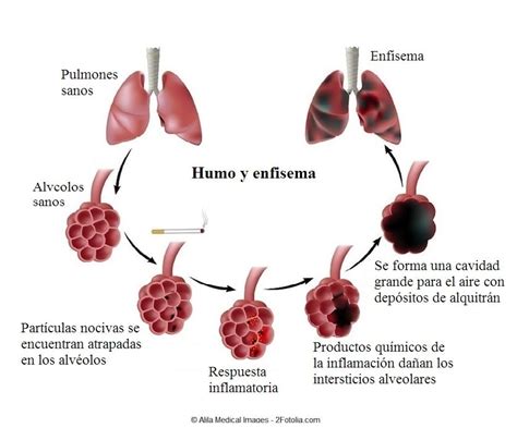 Enfisema Pulmonar Síntomas Causas Edema Bronquitis Tem Cura Y Cuidados